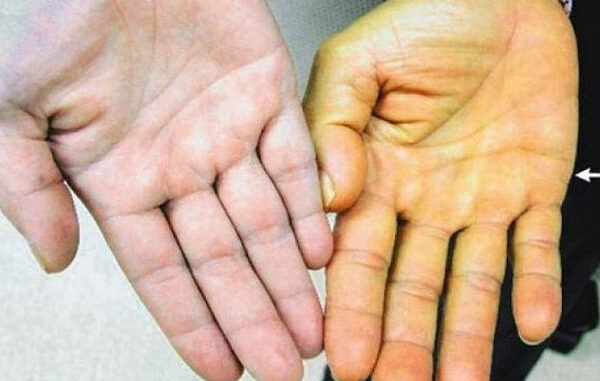 bolesna-jetra-ruke
